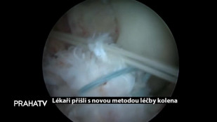 Lékaři přišli s novou metodou léčby kolena